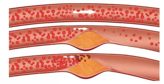 脂肪堆积造成血管狭窄