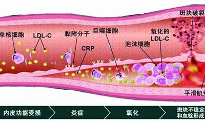 血管里脂质斑块形成过程 血管里脂质斑块形成过程