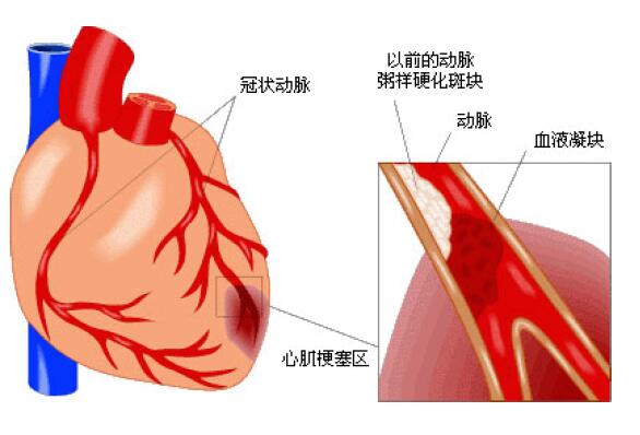 冠状动脉粥样硬化 冠状动脉粥样硬化